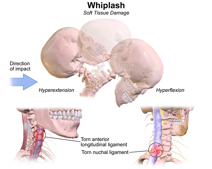 Can A Car Accident Cause Neck Arthritis? 7 Chiropractic for Whiplash in St Johns FL