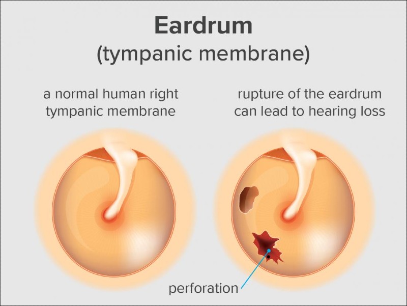 Can You Lose Your Hearing In A Car Accident? 7 Ruptured eardrum