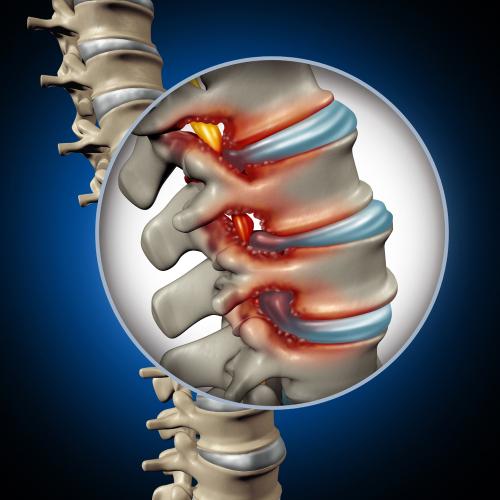 Can A Car Accident Cause Spinal Stenosis? 3 blog spinal stenosis car accident